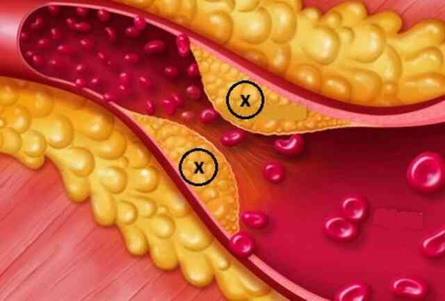 Xây dựng bộ tiêu chí chẩn đoán rối loạn lipid máu theo y học cổ truyền