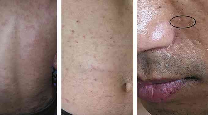 Phát hiện ấu trùng giun tròn chui dưới da người