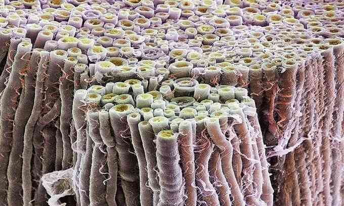 Ghép tế bào gốc điều trị bại liệt