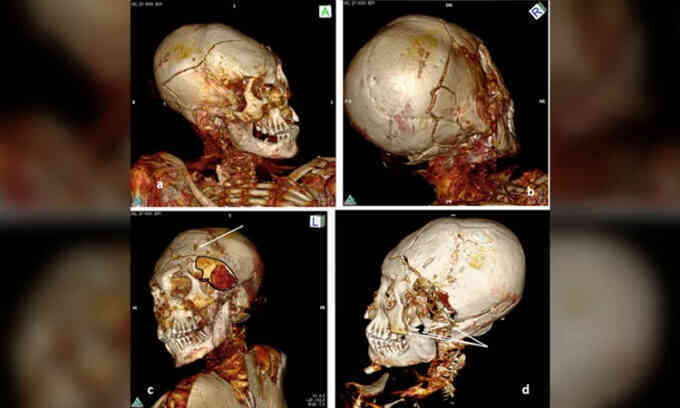 Xác ướp nghìn năm của nạn nhân có khả năng bị giết tàn bạo