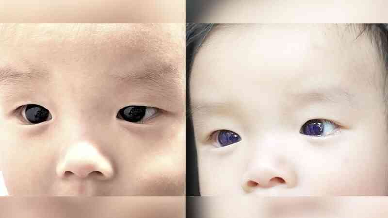 Sau điều trị Covid-19, em bé mắt nâu biến thành mắt xanh