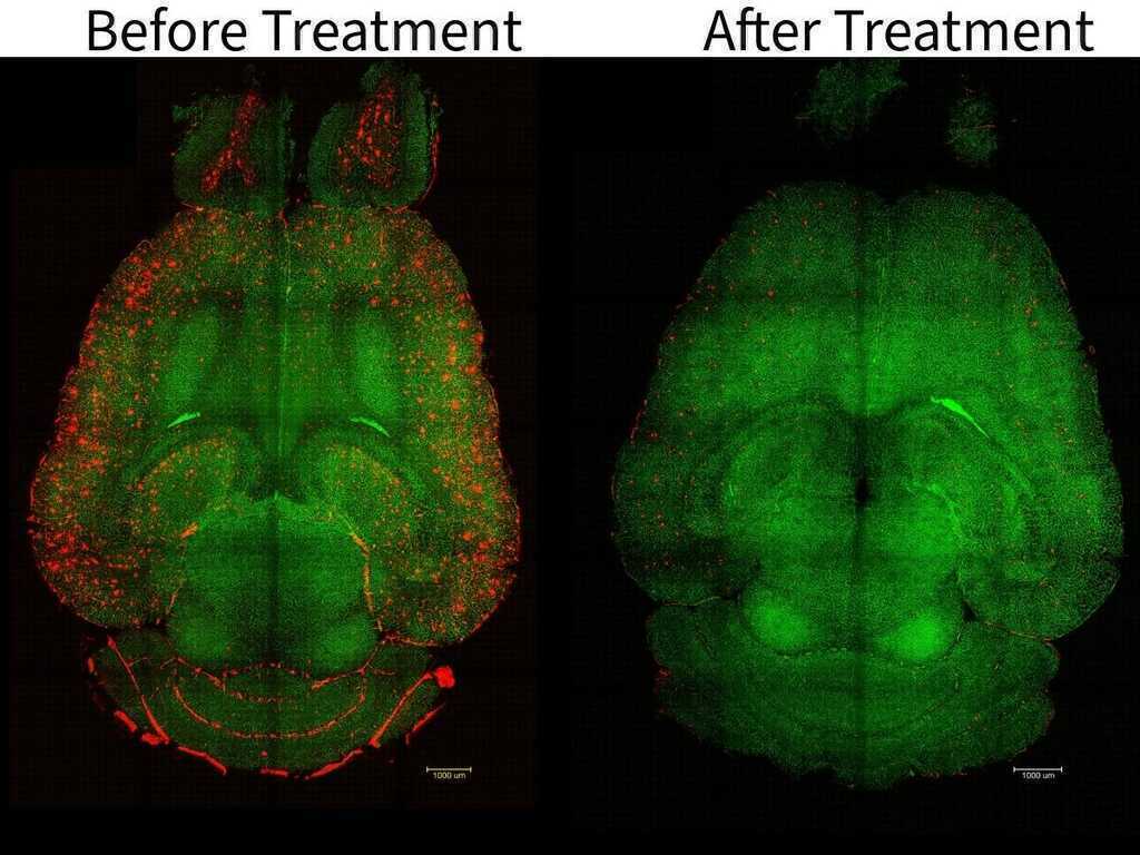Nghiên cứu mở đường chữa khỏi bệnh Alzheimer